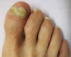 ingrown toenail and infected ingrown toenail