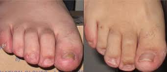 fungal nail infection how do you get it